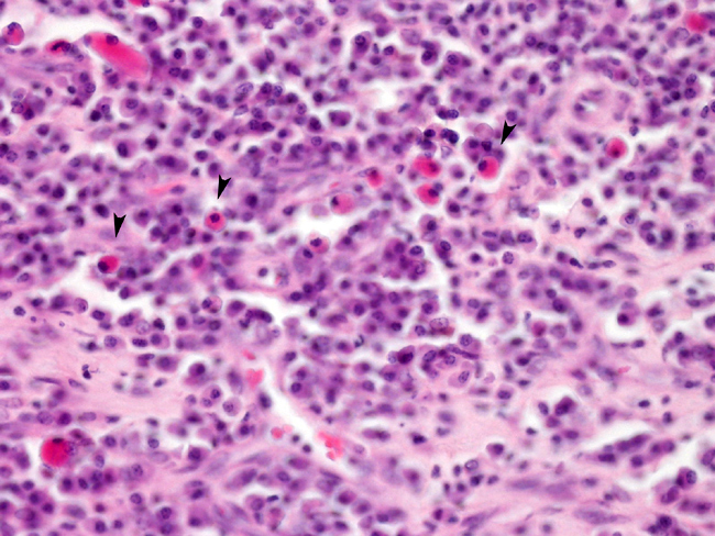 Diagnosis and management of solitary plasmacytoma of bone