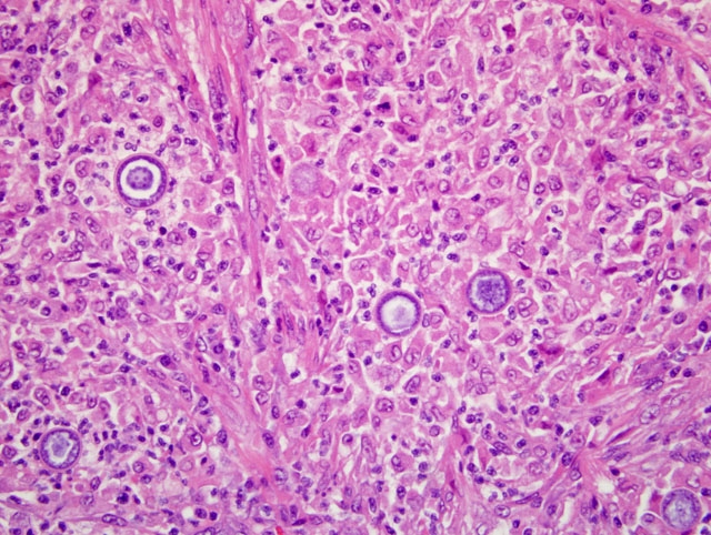 Histoplasmosis - Wikipedia