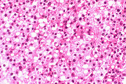 liposarcoma in dogs liposarcoma in dogs pictures to pin on pinsdaddy liposarcoma in dogs liposarcoma in dogs pictures to pin on pinsdaddy
