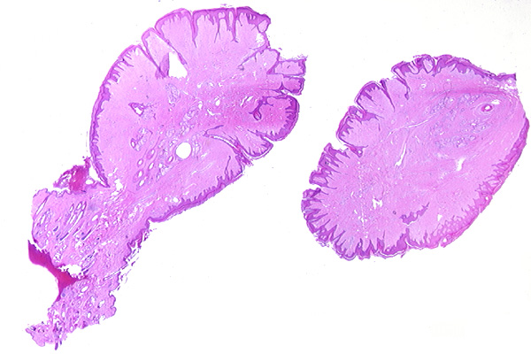 Jóindulatú fibroepithelialis papilloma