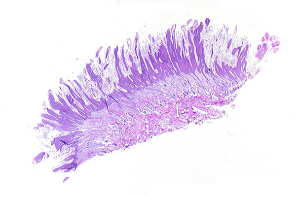 papilloma jpc