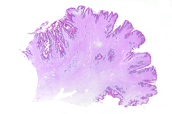 Papilloma jpc. Mandula arok rosszindulatu daganata