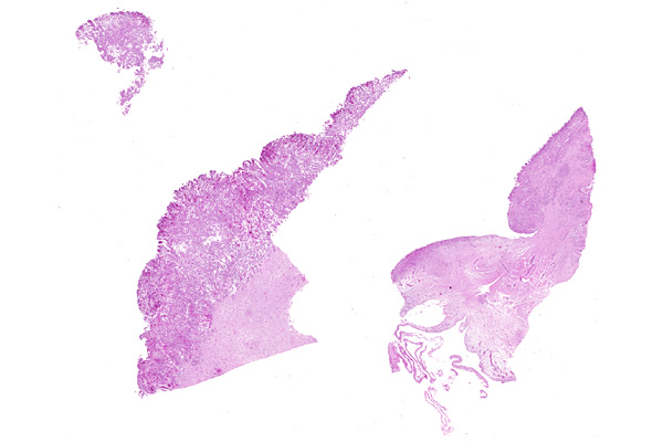 malignant mesothelioma and radiotherapy