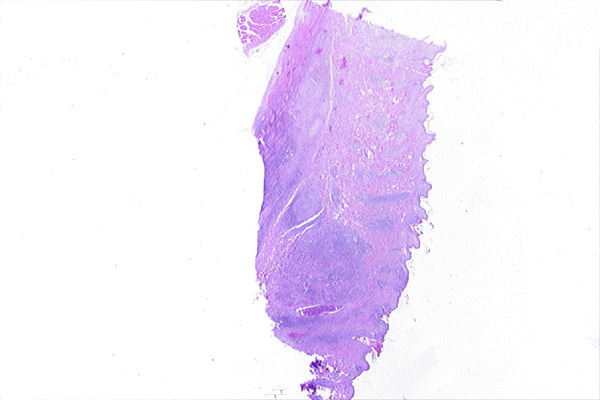 papilloma jpc