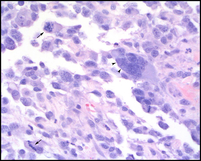 stage 3 papillary thyroid cancer prognosis