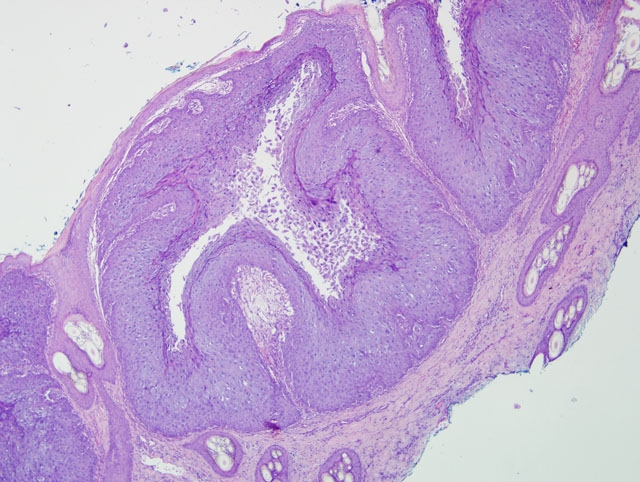 Papilloma jpc, Giardiasis jelentése a gyűlöletben