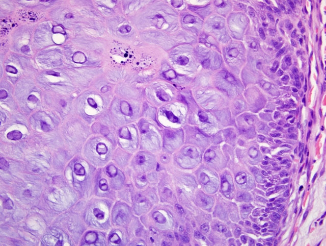 papilloma virus inclusion bodies