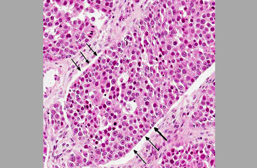 Granulosa cell tumor of ovary histopathology report