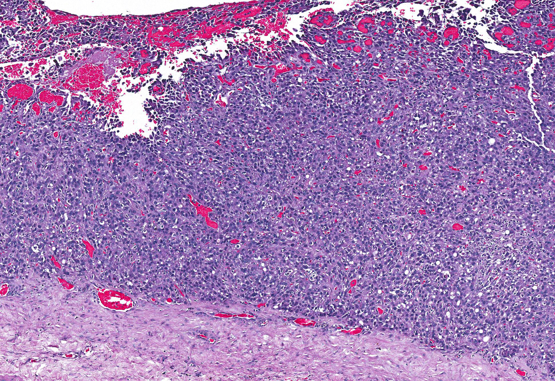 what blood test shows mesothelioma