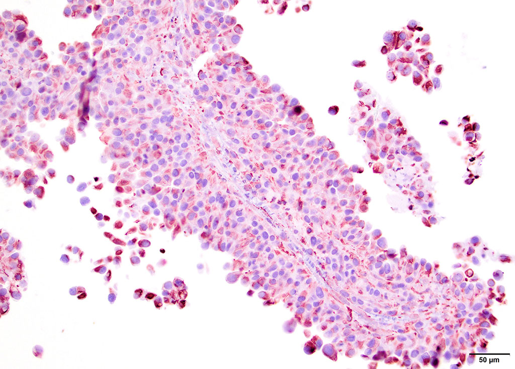 current treatment strategies in malignant pleural mesothelioma with a treatment algorithm