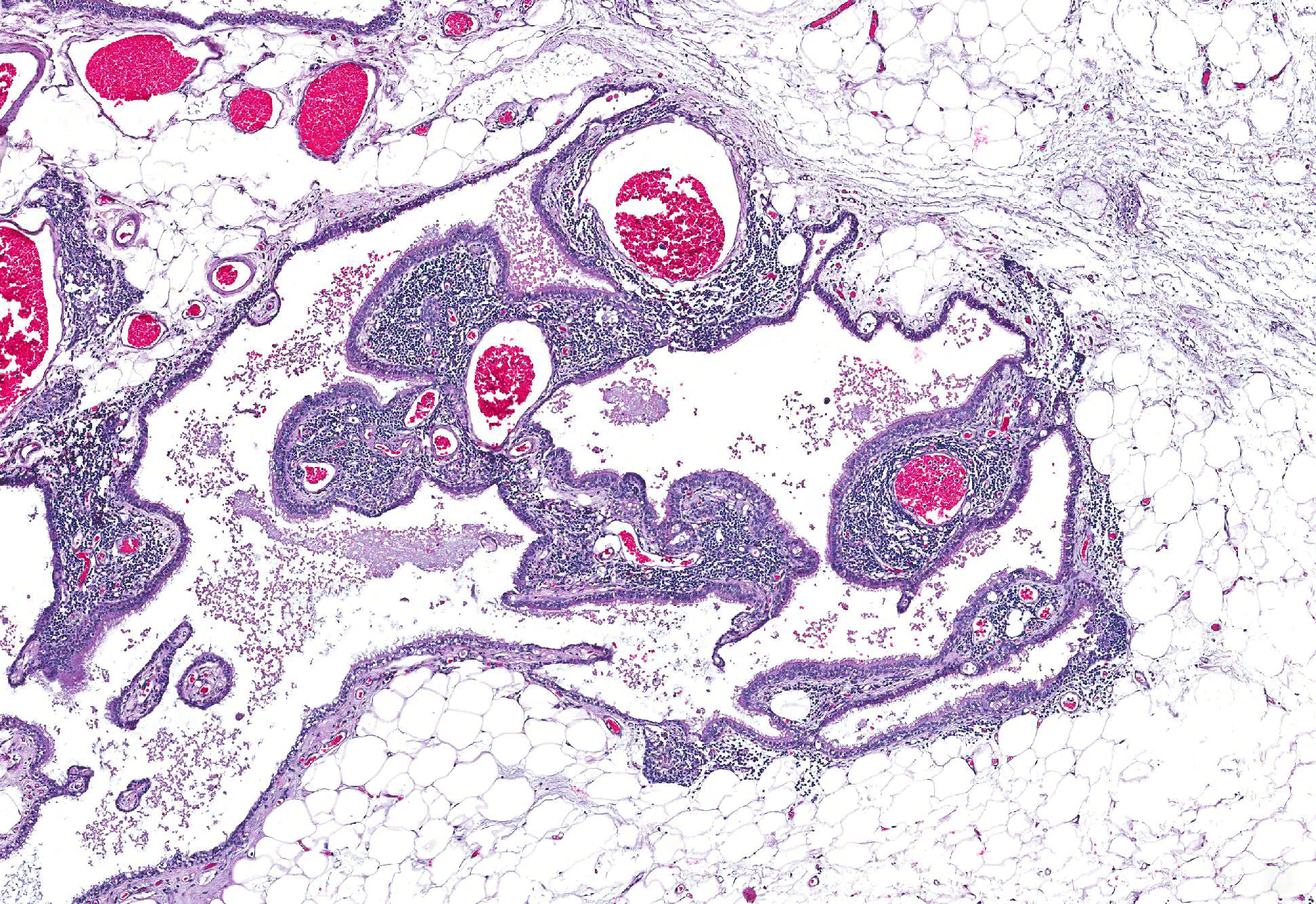 how to detect subcutaneous emphysema