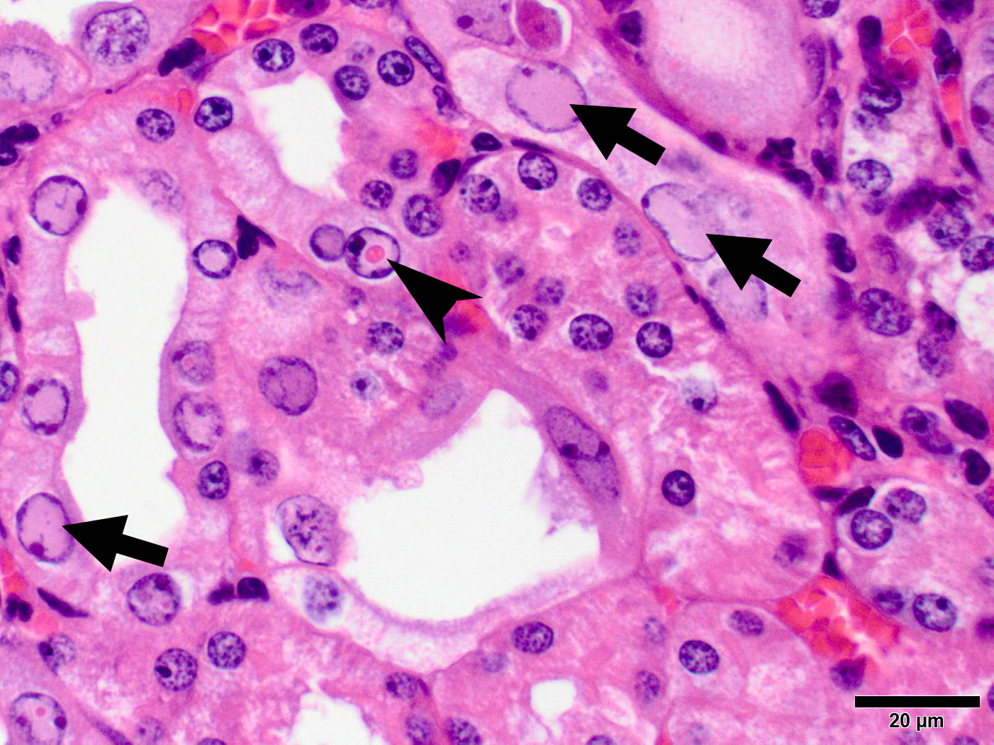 papilloma virus inclusion bodies