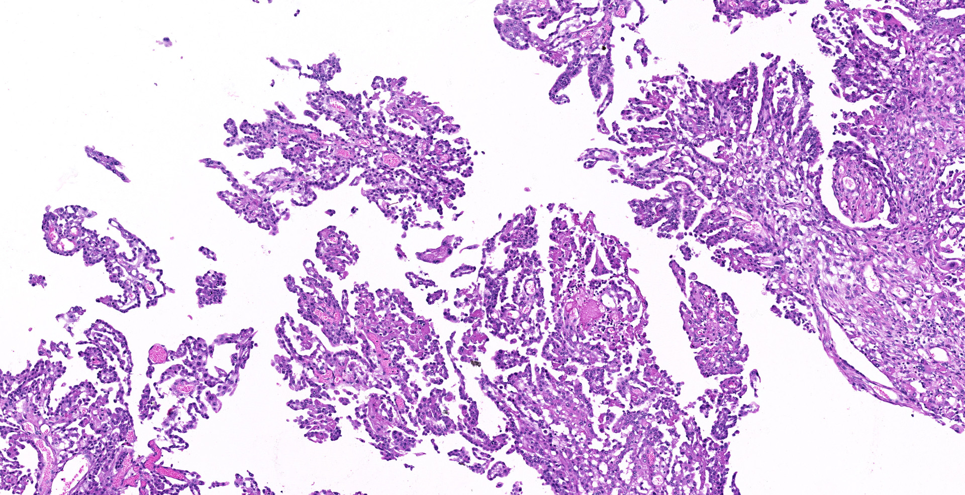 best way to remove squamous cell carcinoma