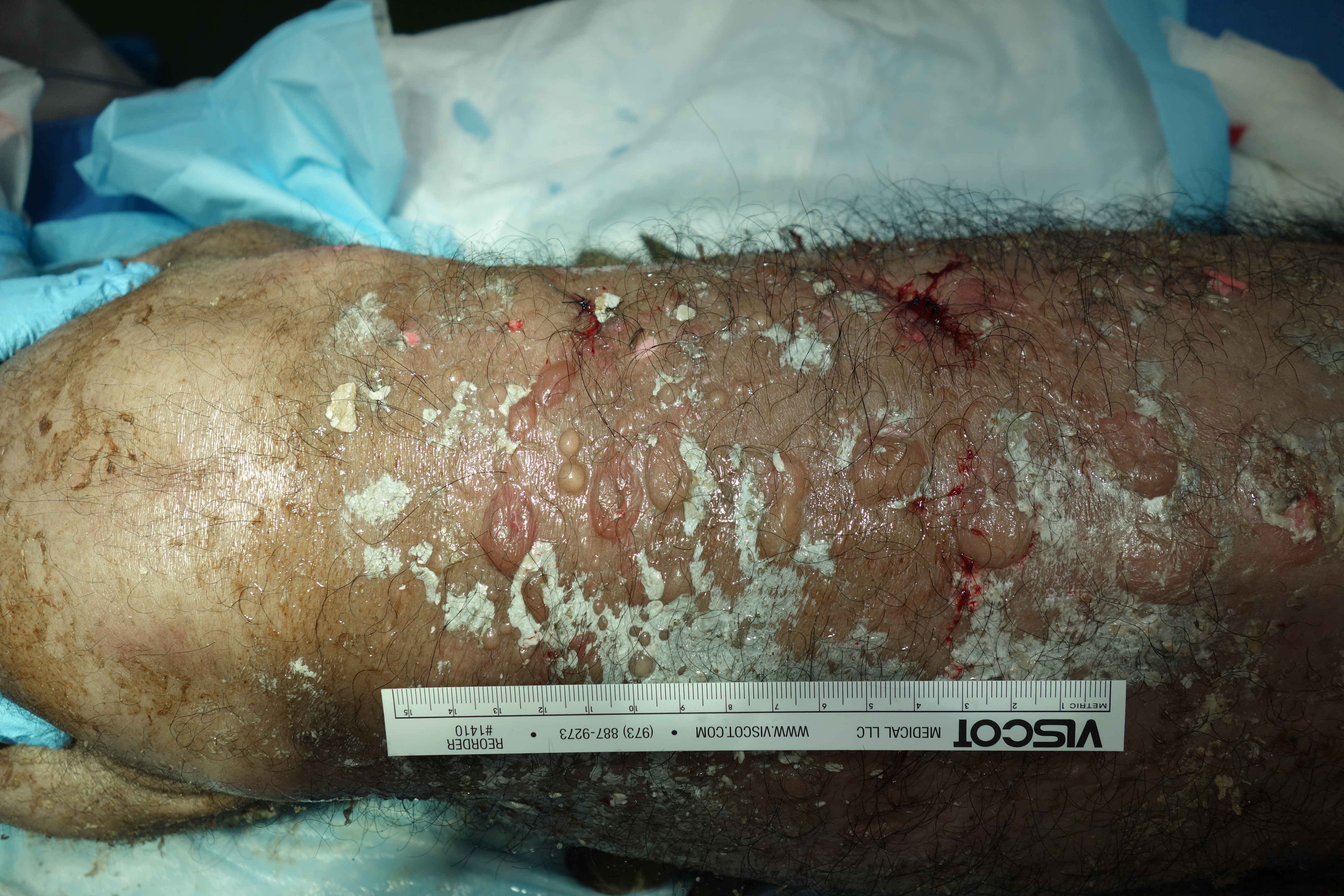 Frontiers  Epidermolysis Bullosa Acquisita: The 2019 Update