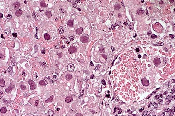 papilloma virus inclusion bodies