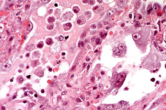 Basophilic viral inclusion body in the nucleus of a hepatocyte of